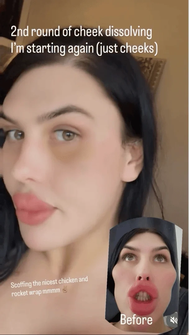 "Britaniyada ən böyük dodaqlara sahib qadın görünüşünü dəyişməyə qərar verib" - "LadBible"