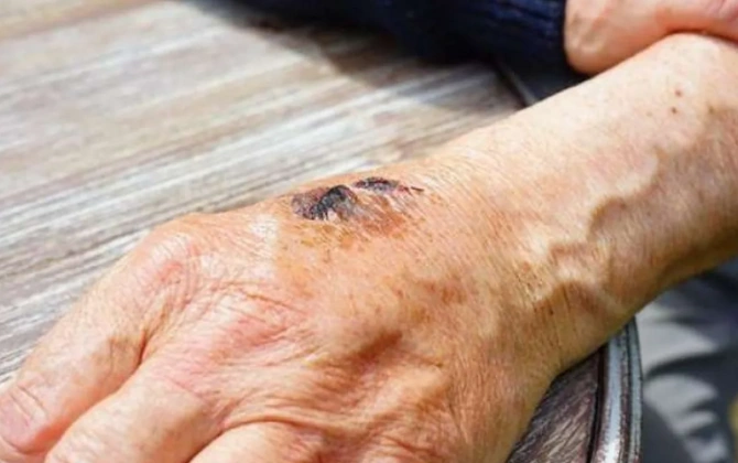 Nazirlik qarayara ilə bağlı epidemioloji vəziyyət barədə MƏLUMAT YAYDI