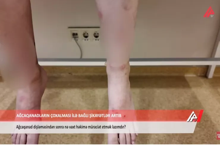 Builki ağcaqanadlar Bakı sakinlərini xəstəxanalıq etdi - VİDEO
